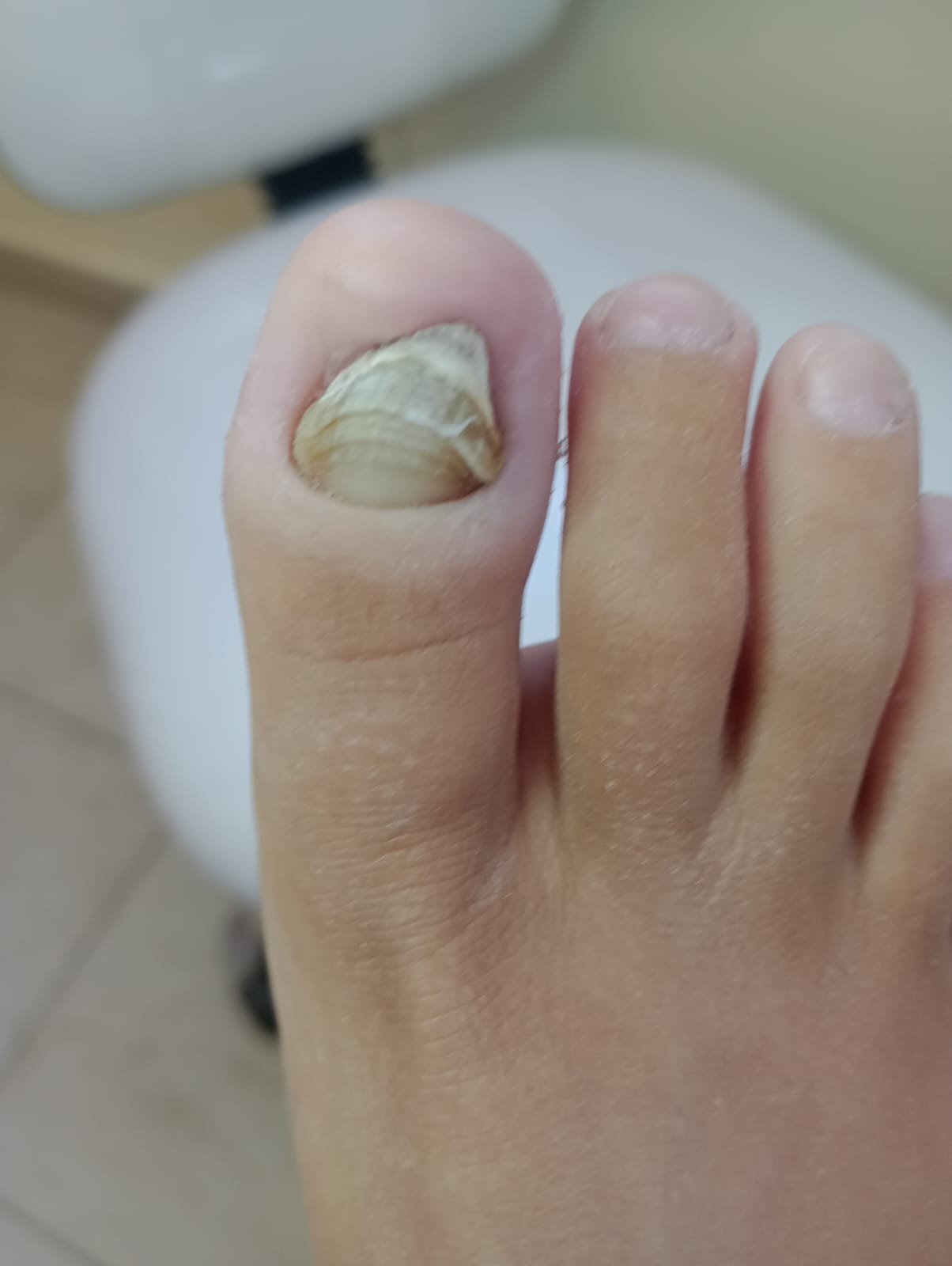 Antes del tratamiento de Onicomicosis (hongo)